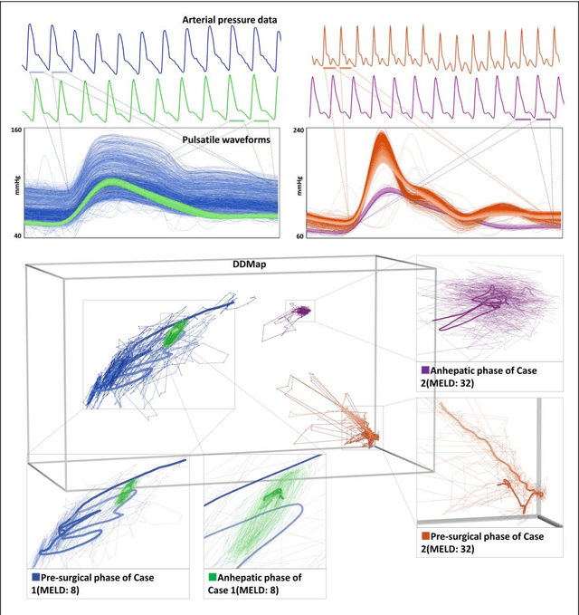 Figure 1 for Discovery of temporal structure intricacy in arterial blood pressure waveforms representing acuity of liver transplant and forecasting short term surgical outcome via unsupervised manifold learning