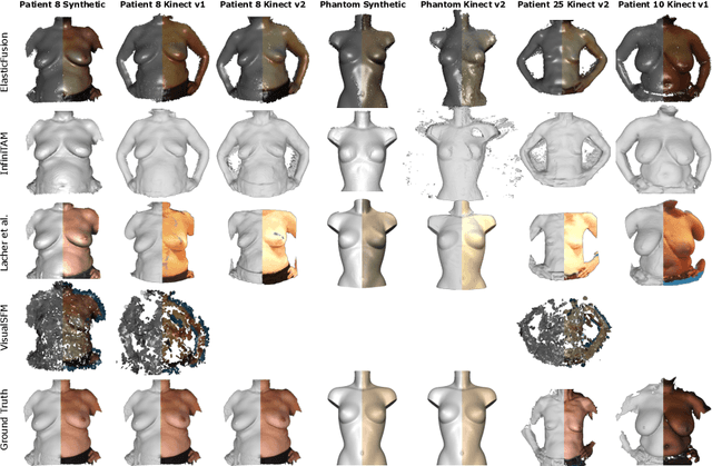 Figure 4 for A comparative study of breast surface reconstruction for aesthetic outcome assessment