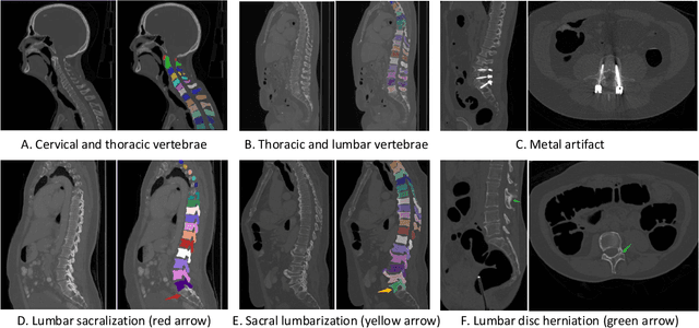 Figure 1 for CTSpine1K: A Large-Scale Dataset for Spinal Vertebrae Segmentation in Computed Tomography