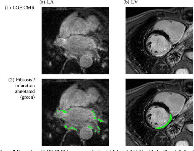 Figure 3 for Recent Advances in Fibrosis and Scar Segmentation from Cardiac MRI: A State-of-the-Art Review and Future Perspectives
