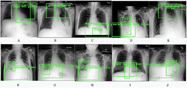 Figure 4 for Weakly supervised one-stage vision and language disease detection using large scale pneumonia and pneumothorax studies