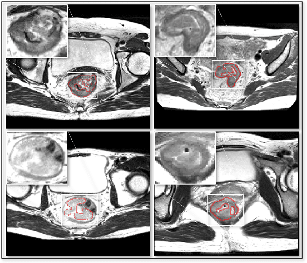Figure 1 for 3D RoI-aware U-Net for Accurate and Efficient Colorectal Tumor Segmentation