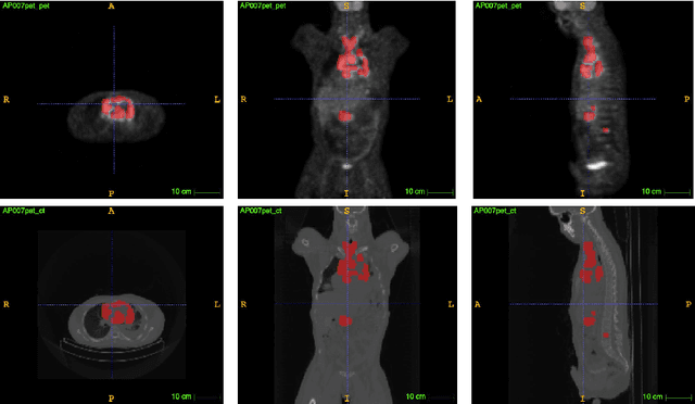 Figure 1 for Evidential segmentation of 3D PET/CT images