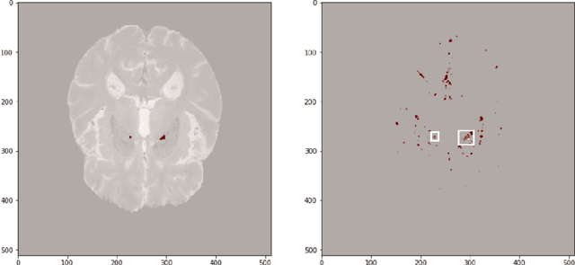 Figure 3 for MixMicrobleed: Multi-stage detection and segmentation of cerebral microbleeds
