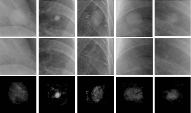 Figure 3 for Extracting and Leveraging Nodule Features with Lung Inpainting for Local Feature Augmentation