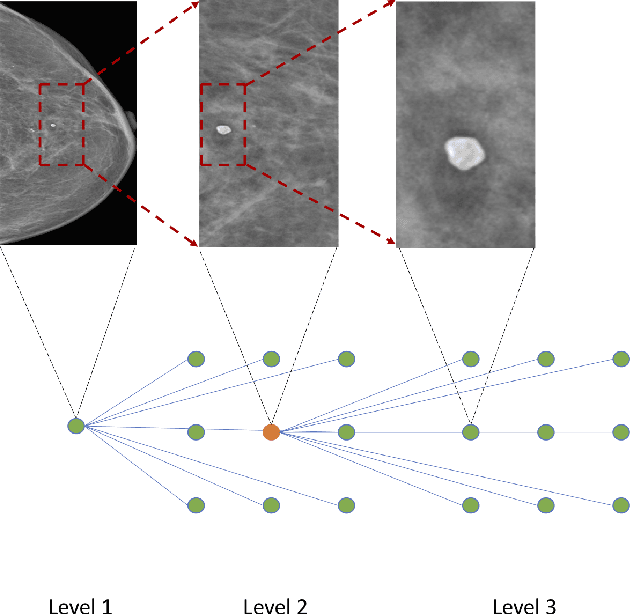 Figure 3 for Zoom in to where it matters: a hierarchical graph based model for mammogram analysis