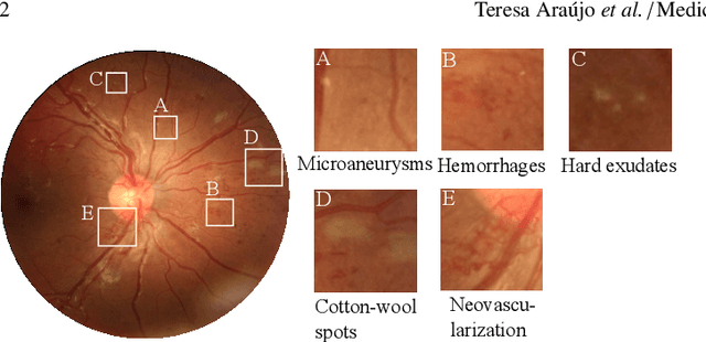 Figure 1 for DR$\vert$GRADUATE: uncertainty-aware deep learning-based diabetic retinopathy grading in eye fundus images