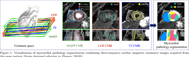 Figure 1 for MyoPS: A Benchmark of Myocardial Pathology Segmentation Combining Three-Sequence Cardiac Magnetic Resonance Images