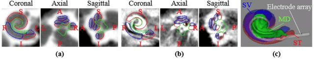 Figure 1 for Atlas-Based Segmentation of Intracochlear Anatomy in Metal Artifact Affected CT Images of the Ear with Co-trained Deep Neural Networks