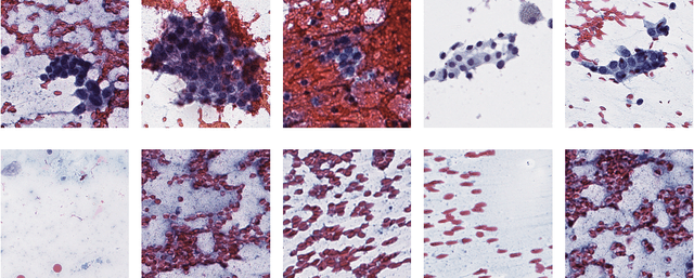 Figure 3 for A Deep-Learning Algorithm for Thyroid Malignancy Prediction From Whole Slide Cytopathology Images