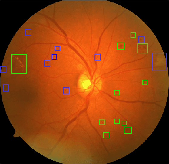 Figure 1 for Pseudo-Labeling for Small Lesion Detection on Diabetic Retinopathy Images
