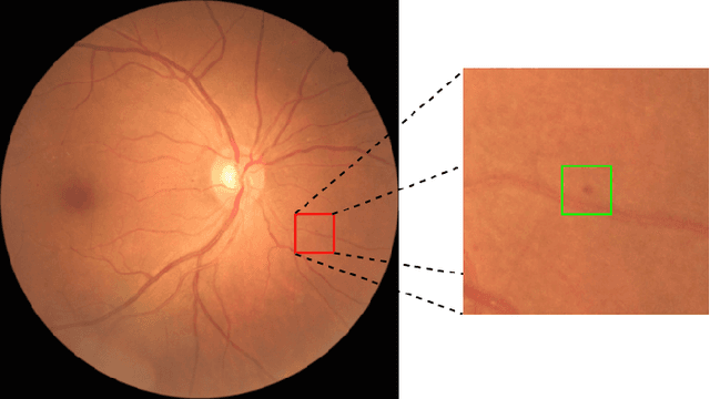Figure 2 for Pseudo-Labeling for Small Lesion Detection on Diabetic Retinopathy Images