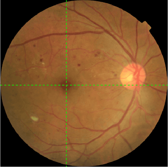 Figure 3 for Pseudo-Labeling for Small Lesion Detection on Diabetic Retinopathy Images