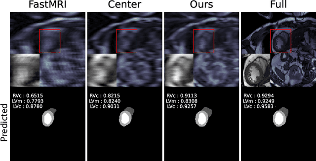 Figure 3 for Optimal MRI Undersampling Patterns for Ultimate Benefit of Medical Vision Tasks