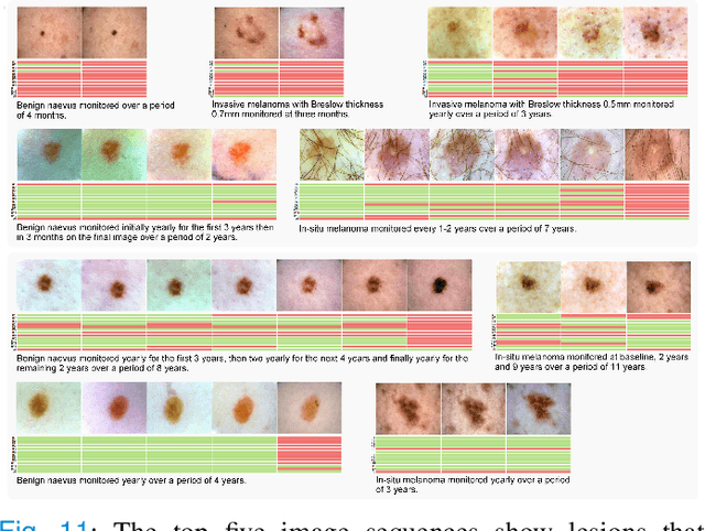 Figure 3 for Early Melanoma Diagnosis with Sequential Dermoscopic Images