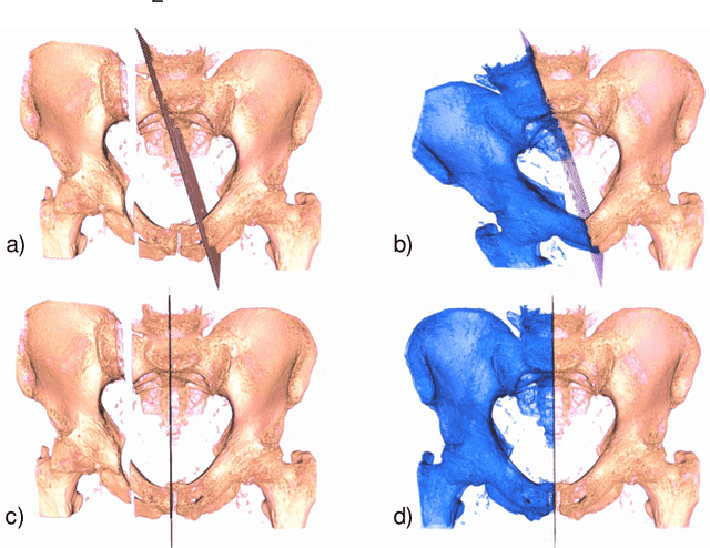 Figure 1 for Exploring Partial Intrinsic and Extrinsic Symmetry in 3D Medical Imaging