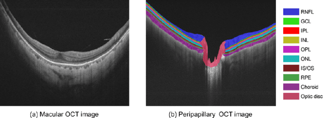 Figure 1 for Multi-scale GCN-assisted two-stage network for joint segmentation of retinal layers and disc in peripapillary OCT images