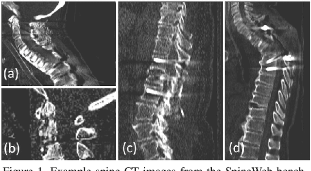 Figure 1 for Automatic Vertebra Localization and Identification in CT by Spine Rectification and Anatomically-constrained Optimization