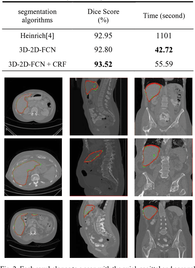 Figure 2 for Liver segmentation in CT images using three dimensional to two dimensional fully convolutional network