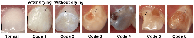 Figure 3 for A Smartphone-based System for Real-time Early Childhood Caries Diagnosis