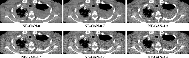 Figure 4 for Noise Entangled GAN For Low-Dose CT Simulation