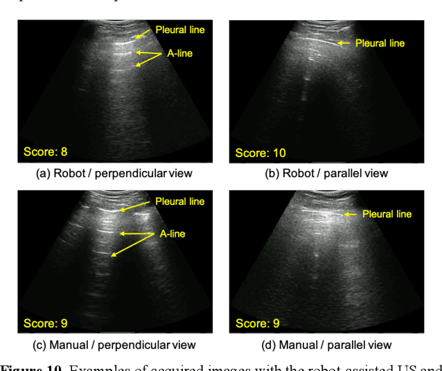 Figure 2 for Tele-operative Robotic Lung Ultrasound Scanning Platform for Triage of COVID-19 Patients