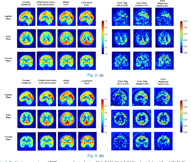 Figure 4 for MRI to PET Cross-Modality Translation using Globally and Locally Aware GAN (GLA-GAN) for Multi-Modal Diagnosis of Alzheimer's Disease