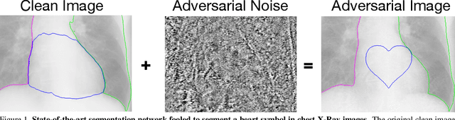 Figure 1 for Adversarial Heart Attack: Neural Networks Fooled to Segment Heart Symbols in Chest X-Ray Images