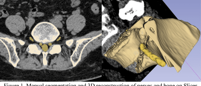 Figure 1 for Deep learning based automatic segmentation of lumbosacral nerves on non-contrast CT for radiographic evaluation: a pilot study