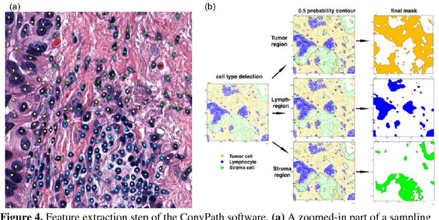 Figure 4 for ConvPath: A Software Tool for Lung Adenocarcinoma Digital Pathological Image Analysis Aided by Convolutional Neural Network