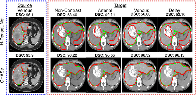 Figure 1 for Co-Heterogeneous and Adaptive Segmentation from Multi-Source and Multi-Phase CT Imaging Data: A Study on Pathological Liver and Lesion Segmentation