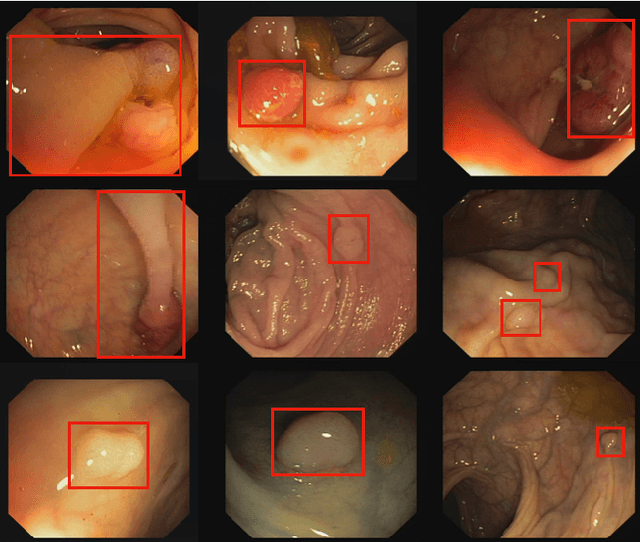 Figure 1 for Colorectal Polyp Segmentation by U-Net with Dilation Convolution