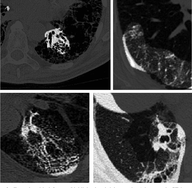 Figure 4 for Fibrosis-Net: A Tailored Deep Convolutional Neural Network Design for Prediction of Pulmonary Fibrosis Progression from Chest CT Images
