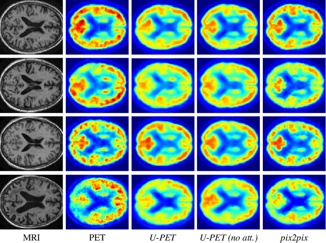Figure 4 for U-PET: MRI-based Dementia Detection with Joint Generation of Synthetic FDG-PET Images