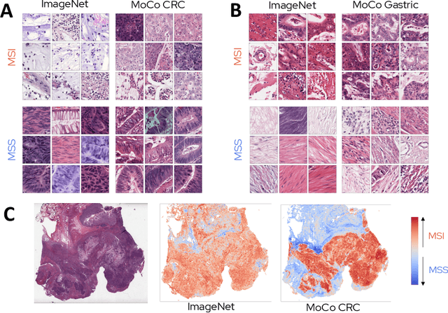 Figure 4 for Self supervised learning improves dMMR/MSI detection from histology slides across multiple cancers