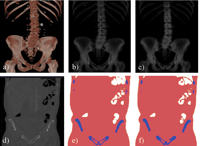 Figure 2 for DeepDRR -- A Catalyst for Machine Learning in Fluoroscopy-guided Procedures