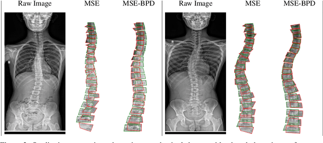 Figure 2 for Bipartite Distance for Shape-Aware Landmark Detection in Spinal X-Ray Images