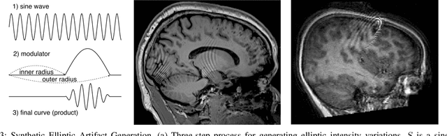 Figure 3 for Localized Motion Artifact Reduction on Brain MRI Using Deep Learning with Effective Data Augmentation Techniques