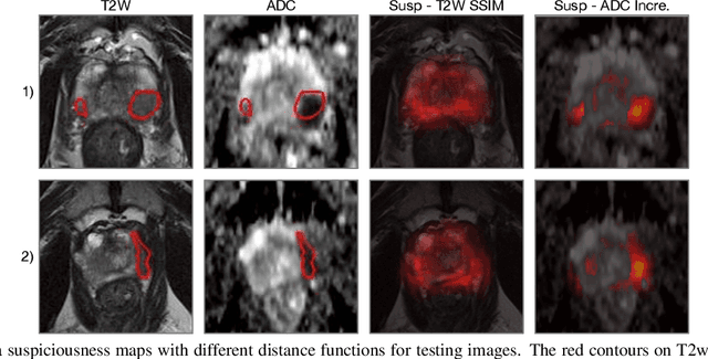 Figure 4 for Prostate cancer inference via weakly-supervised learning using a large collection of negative MRI