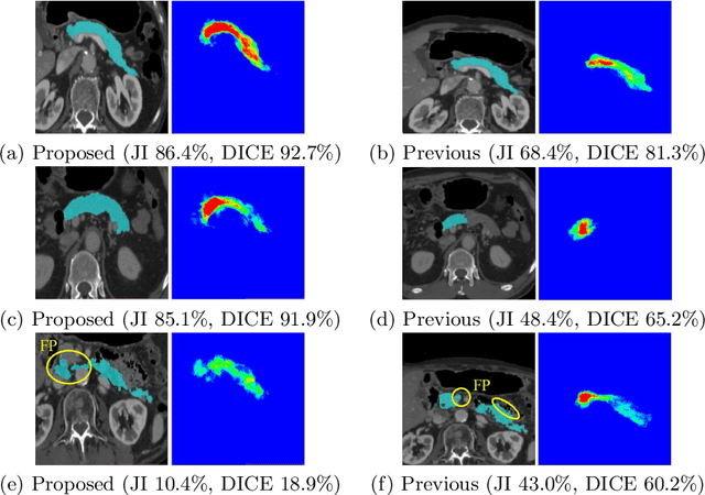 Figure 4 for Regression Forest-Based Atlas Localization and Direction Specific Atlas Generation for Pancreas Segmentation