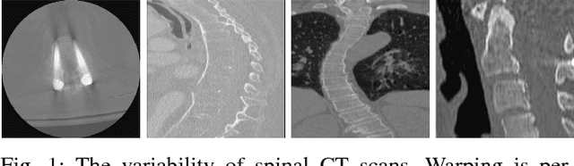 Figure 1 for Joint Vertebrae Identification and Localization in Spinal CT Images by Combining Short- and Long-Range Contextual Information