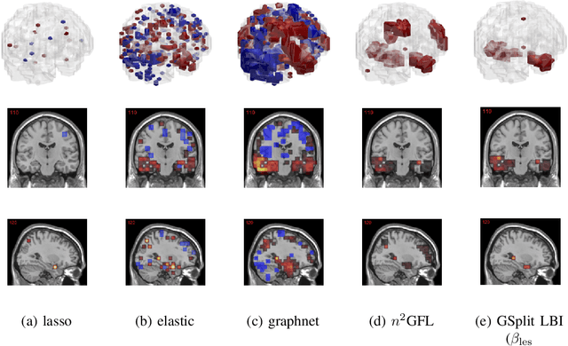 Figure 2 for Leveraging both Lesion Features and Procedural Bias in Neuroimaging: An Dual-Task Split dynamics of inverse scale space