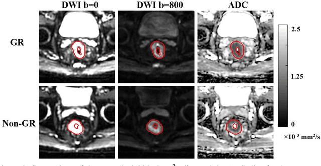 Figure 4 for Deep Learning-based Radiomic Features for Improving Neoadjuvant Chemoradiation Response Prediction in Locally Advanced Rectal Cancer