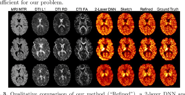 Figure 3 for Learning Myelin Content in Multiple Sclerosis from Multimodal MRI through Adversarial Training