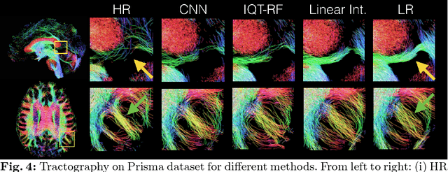 Figure 4 for Bayesian Image Quality Transfer with CNNs: Exploring Uncertainty in dMRI Super-Resolution