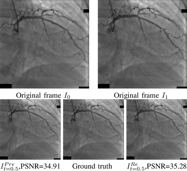 Figure 2 for Reducing the X-ray radiation exposure frequency in cardio-angiography via deep-learning based video interpolation