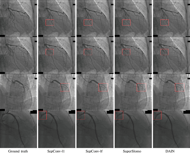 Figure 4 for Reducing the X-ray radiation exposure frequency in cardio-angiography via deep-learning based video interpolation