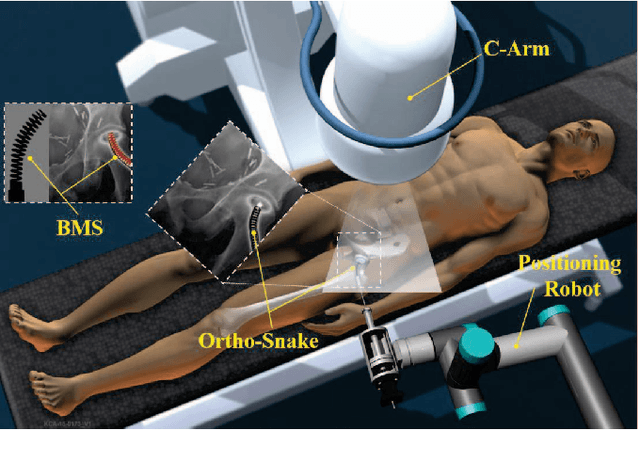 Figure 1 for Inroads Toward Robot-Assisted Internal Fixation of Bone Fractures Using a Bendable Medical Screw and the Curved Drilling Technique