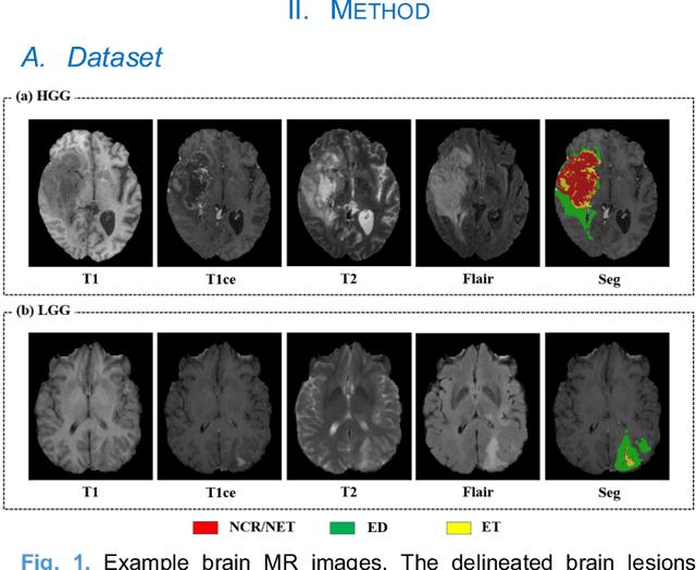 Figure 1 for Expert Knowledge-guided Geometric Representation Learning for Magnetic Resonance Imaging-based Glioma Grading