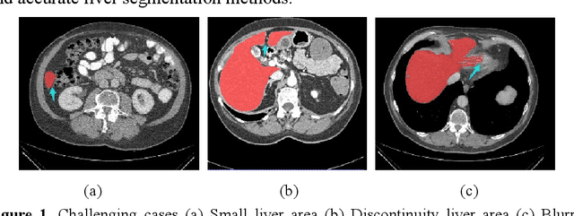 Figure 1 for SAR-U-Net: squeeze-and-excitation block and atrous spatial pyramid pooling based residual U-Net for automatic liver CT segmentation